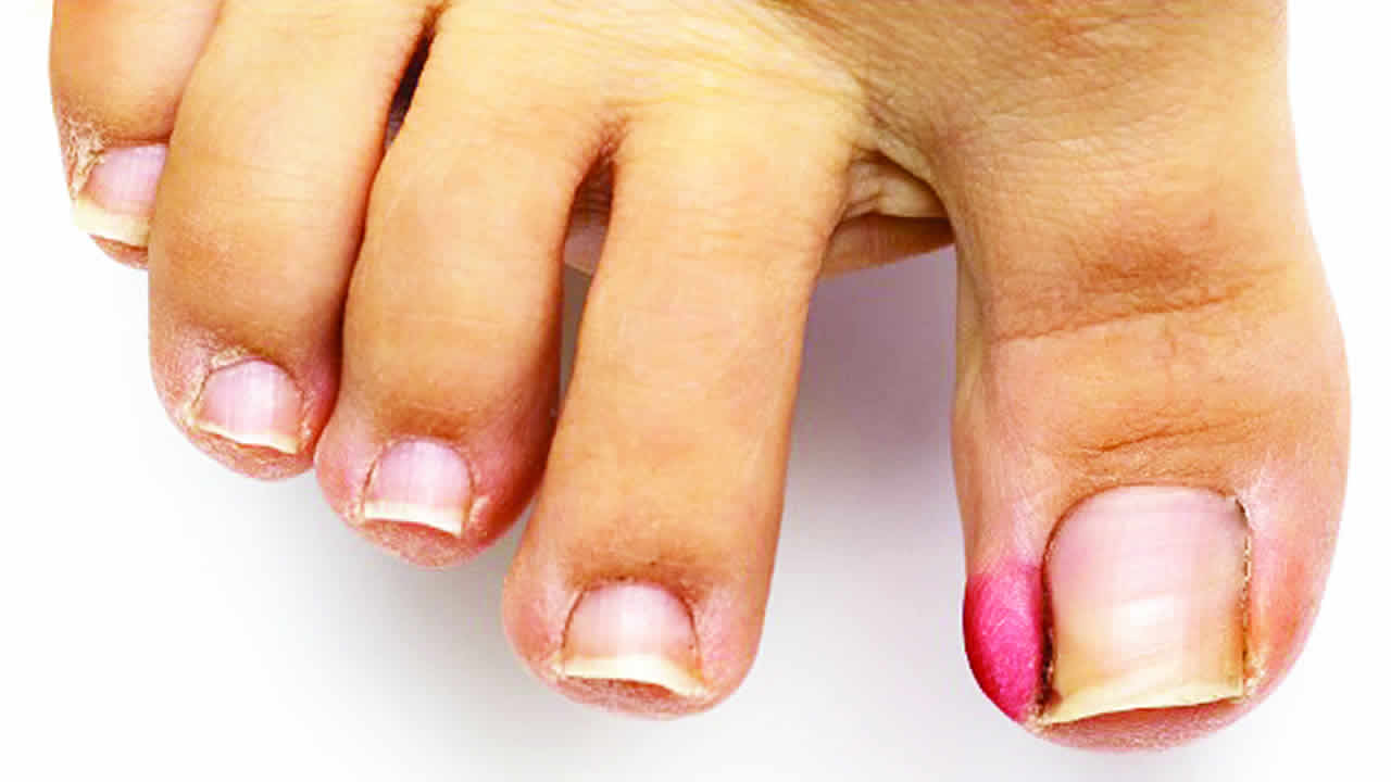 Why your toenail is turning against you