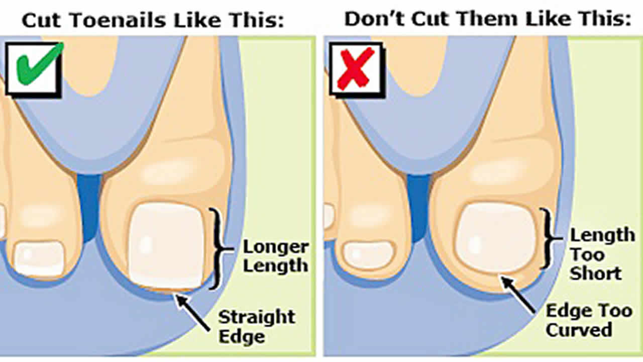 Why your toenail is turning against you